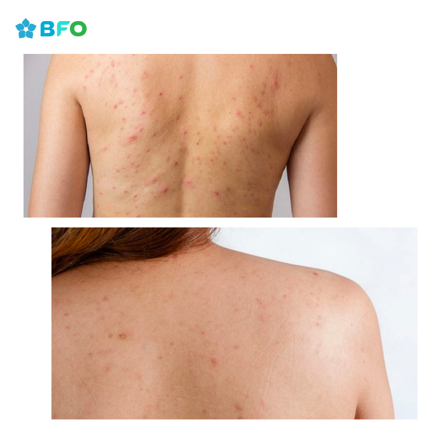 5 Cách trị mụn lưng hiệu quả cho nàng thêm tự tin