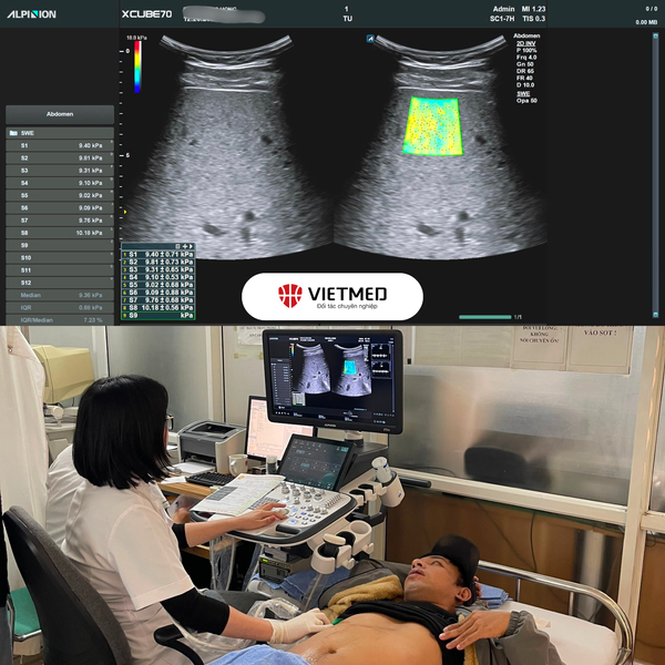 Gan nhiễm mỡ – lựa chọn phương pháp nào để chẩn đoán?