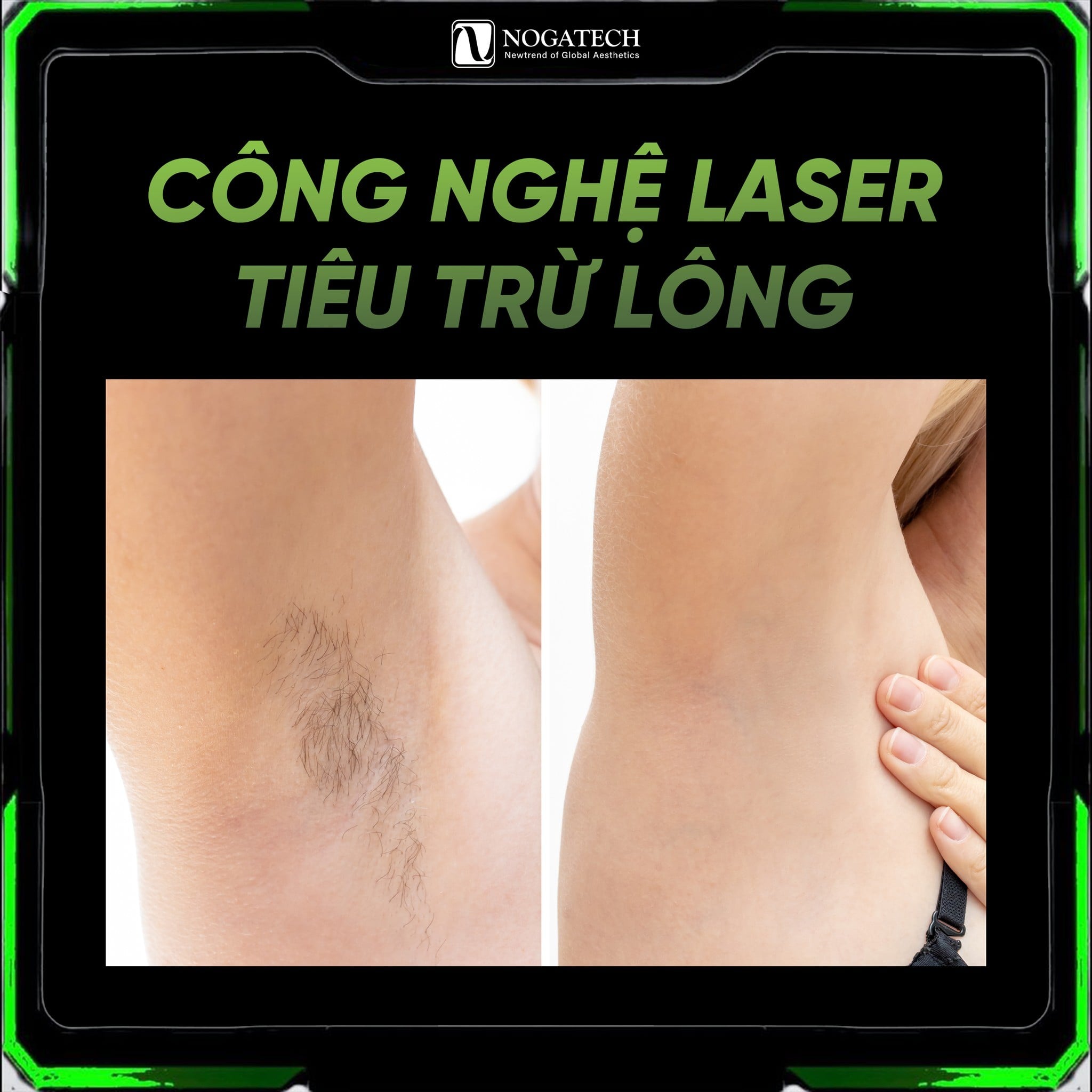 MÁY TRIỆT LÔNG DIODE LASER: THIẾT BỊ XU HƯỚNG CHO SPA & TMV