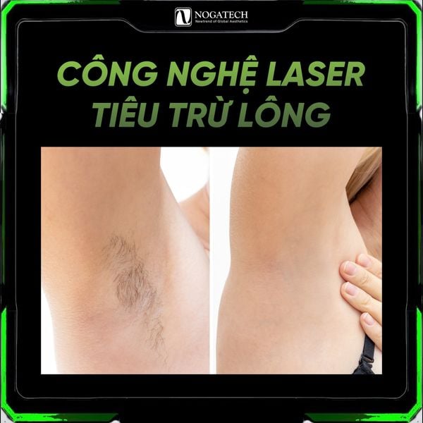 MÁY TRIỆT LÔNG DIODE LASER: THIẾT BỊ XU HƯỚNG CHO SPA & TMV