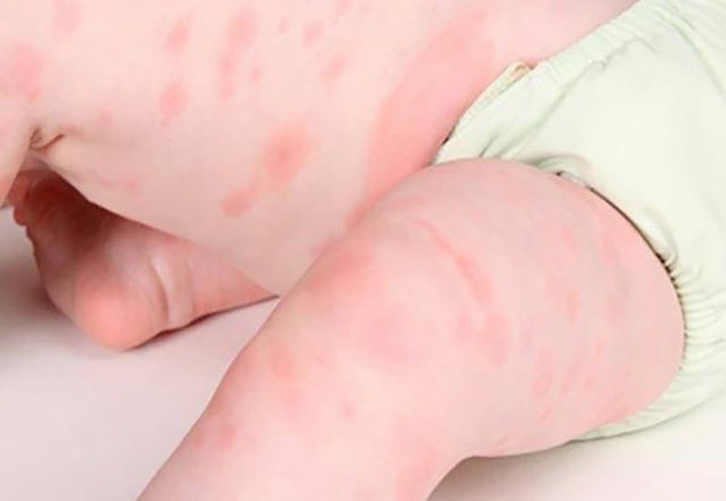 Nhận biết triệu chứng và dấu hiệu trẻ bị dị ứng sữa công thức