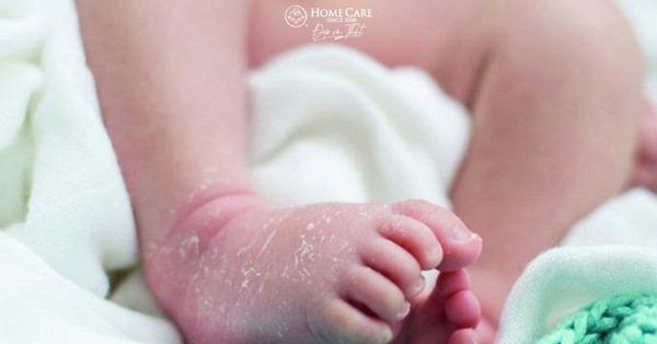 Da trẻ sơ sinh bị khô và sần: 5 Nguyên nhân tác động, hướng dẫn Mẹ cách chăm sóc