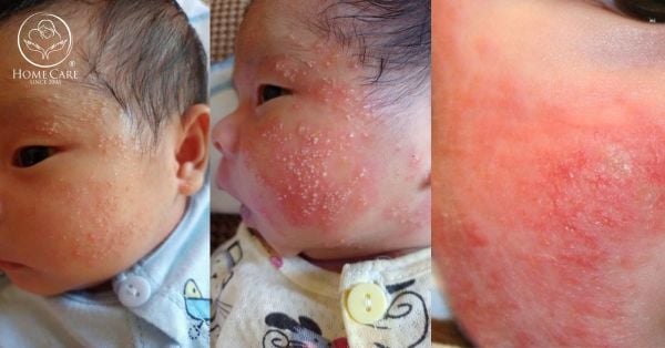 Hình ảnh bé bị chàm sữa và Hướng dẫn từng bước xử lý tại nhà