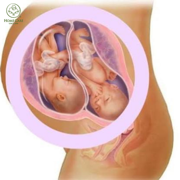 Mẹ bầu mang đa thai hoặc thai lớn