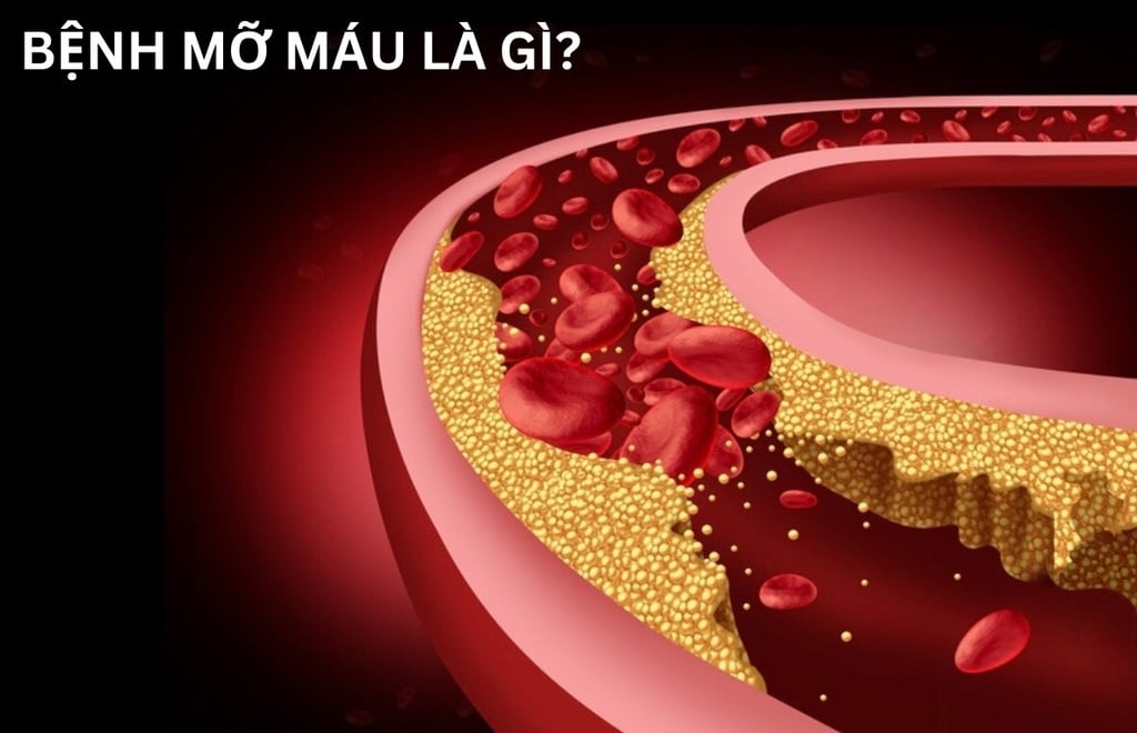 Bệnh mỡ máu là gì? Có nguy hiểm không?