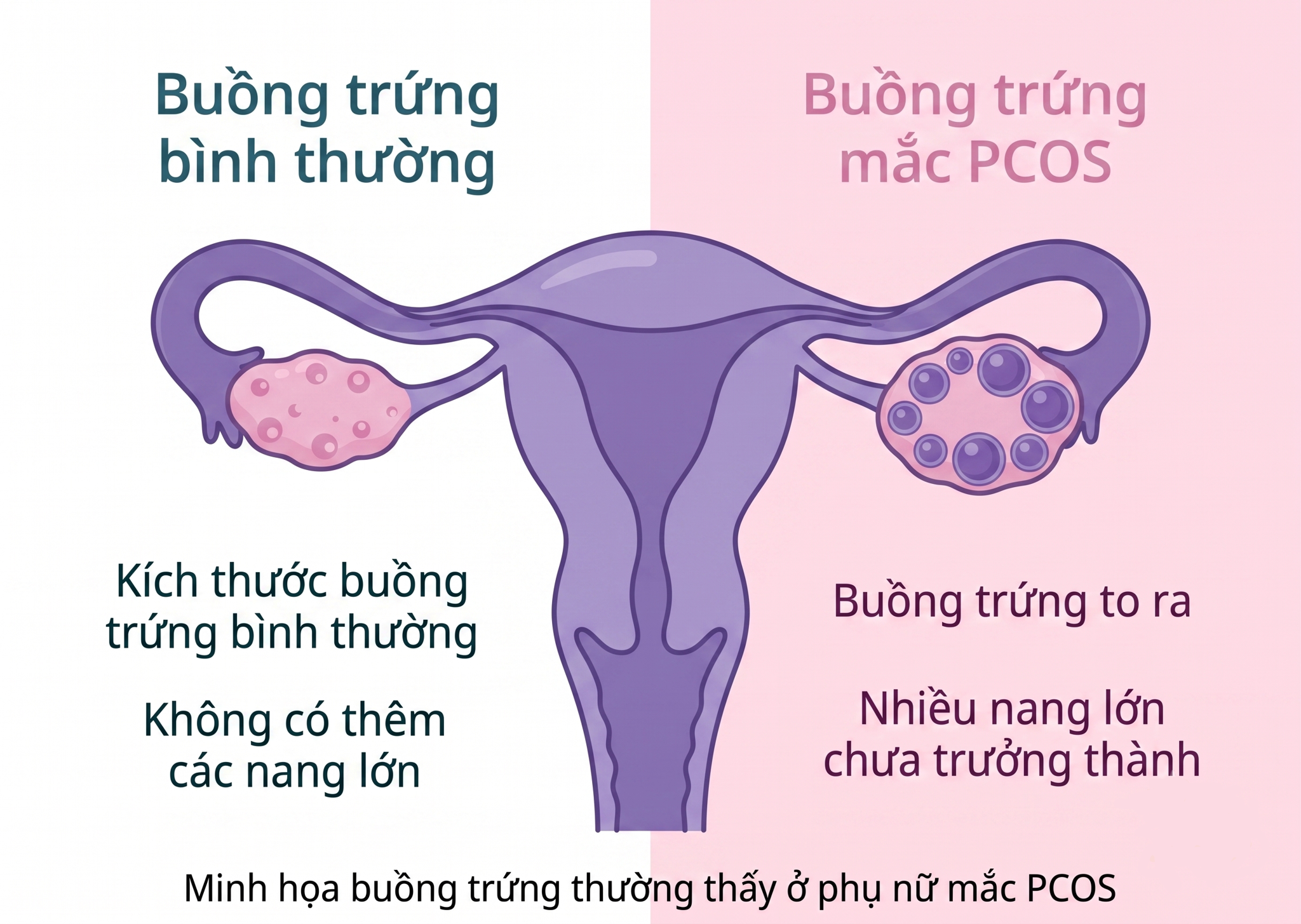 PCOS-la-gi