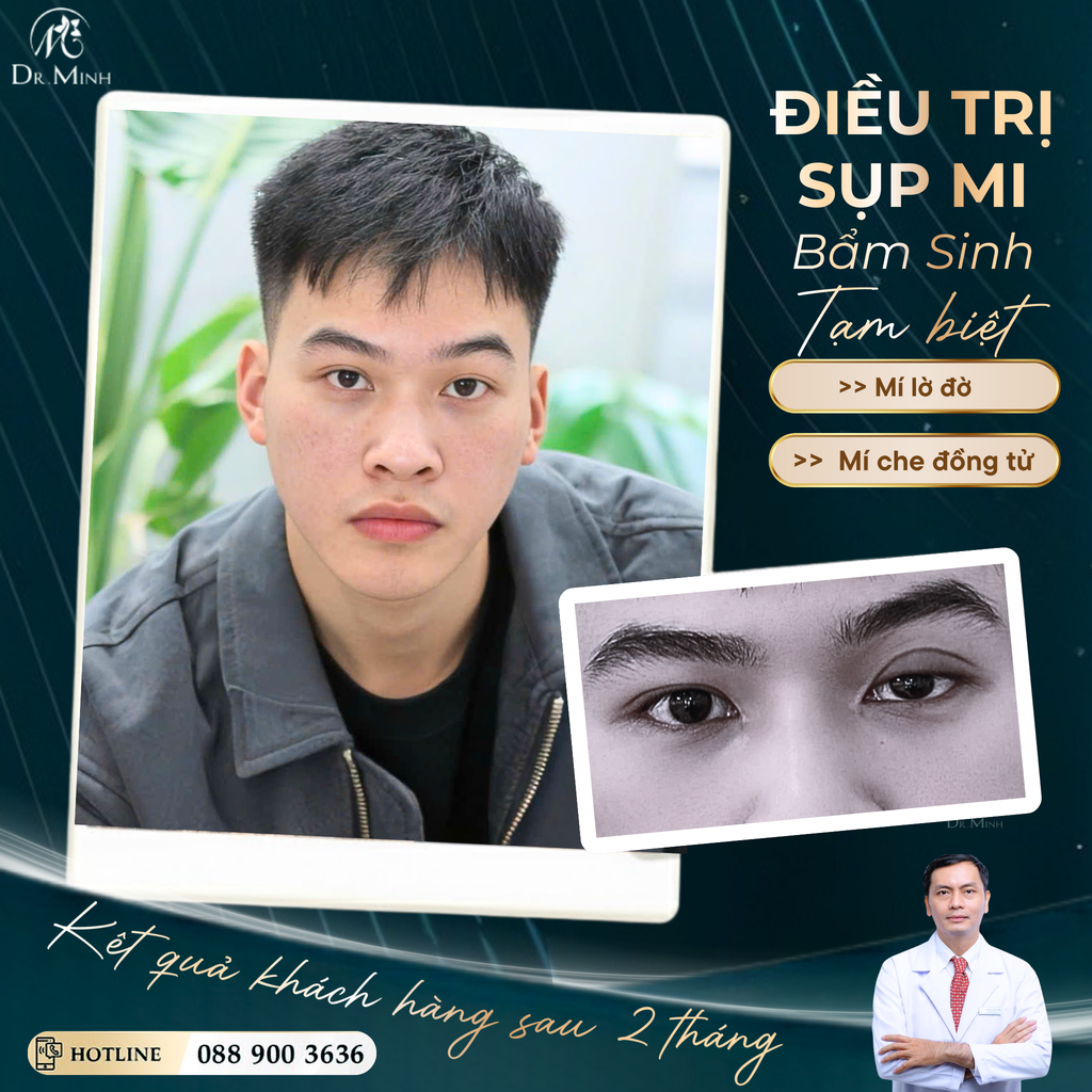 Ca sụp mi bẩm sinh bị làm hỏng vì nhấn mí: vì sao cuối cùng Huy vẫn phải trở lại với phác đồ ban đầu của bác sĩ Minh?