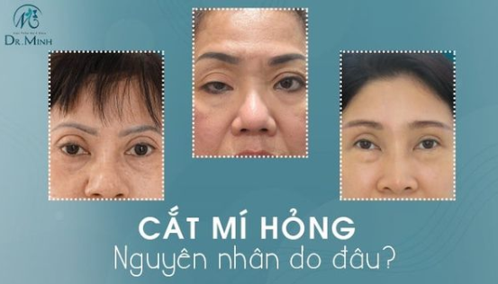 SỬA MÍ HỎNG