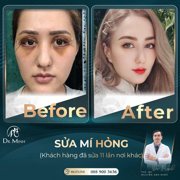 Lý Kim Ngân và cuộc hành trình bước ra khỏi bóng tối của đôi mắt hỏng sau 11 lần sửa mí nơi không uy tín