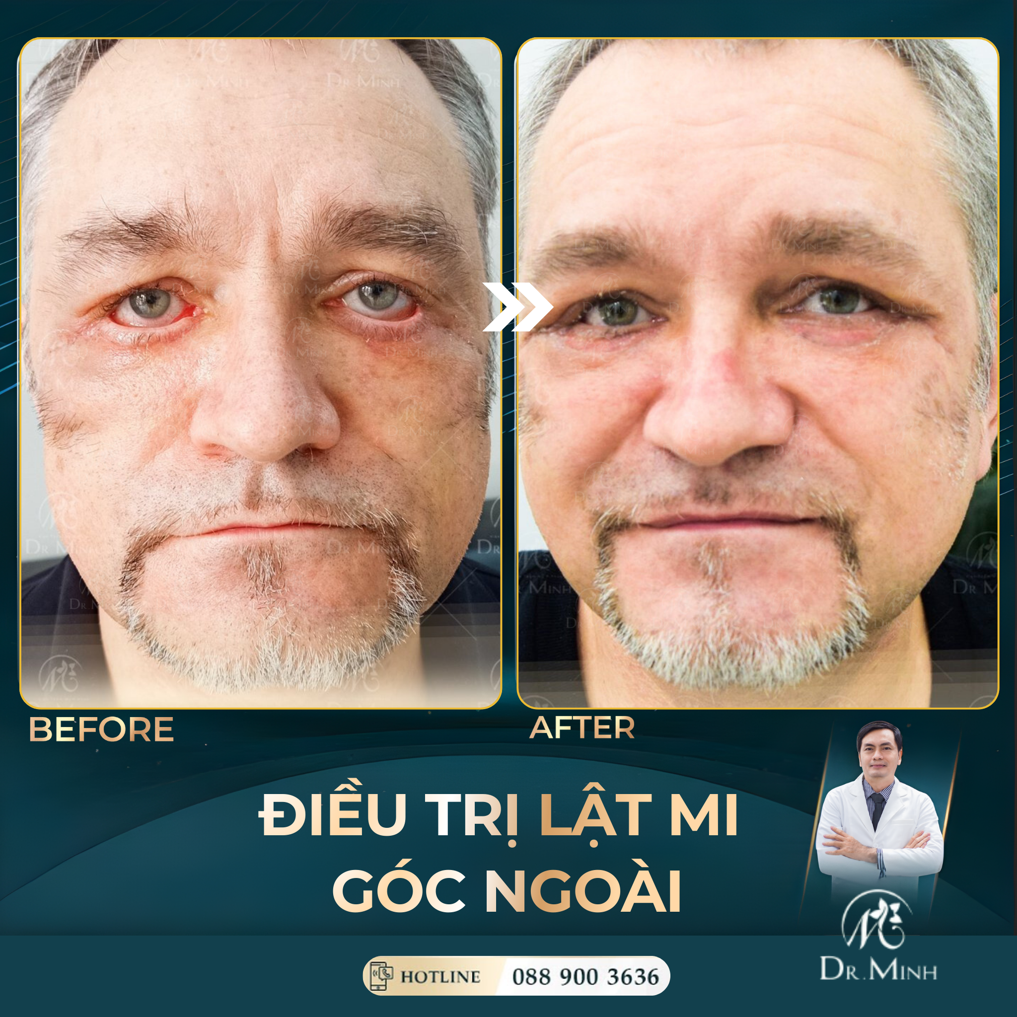 Ca lật mi hiếm gặp của vị giám đốc người nước ngoài: Khi một quyết định làm đẹp sai chỗ suýt đánh đổi cả thị lực