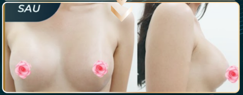 NÂNG NGỰC NANOCHIP ERGONOMIX - MOTIVA