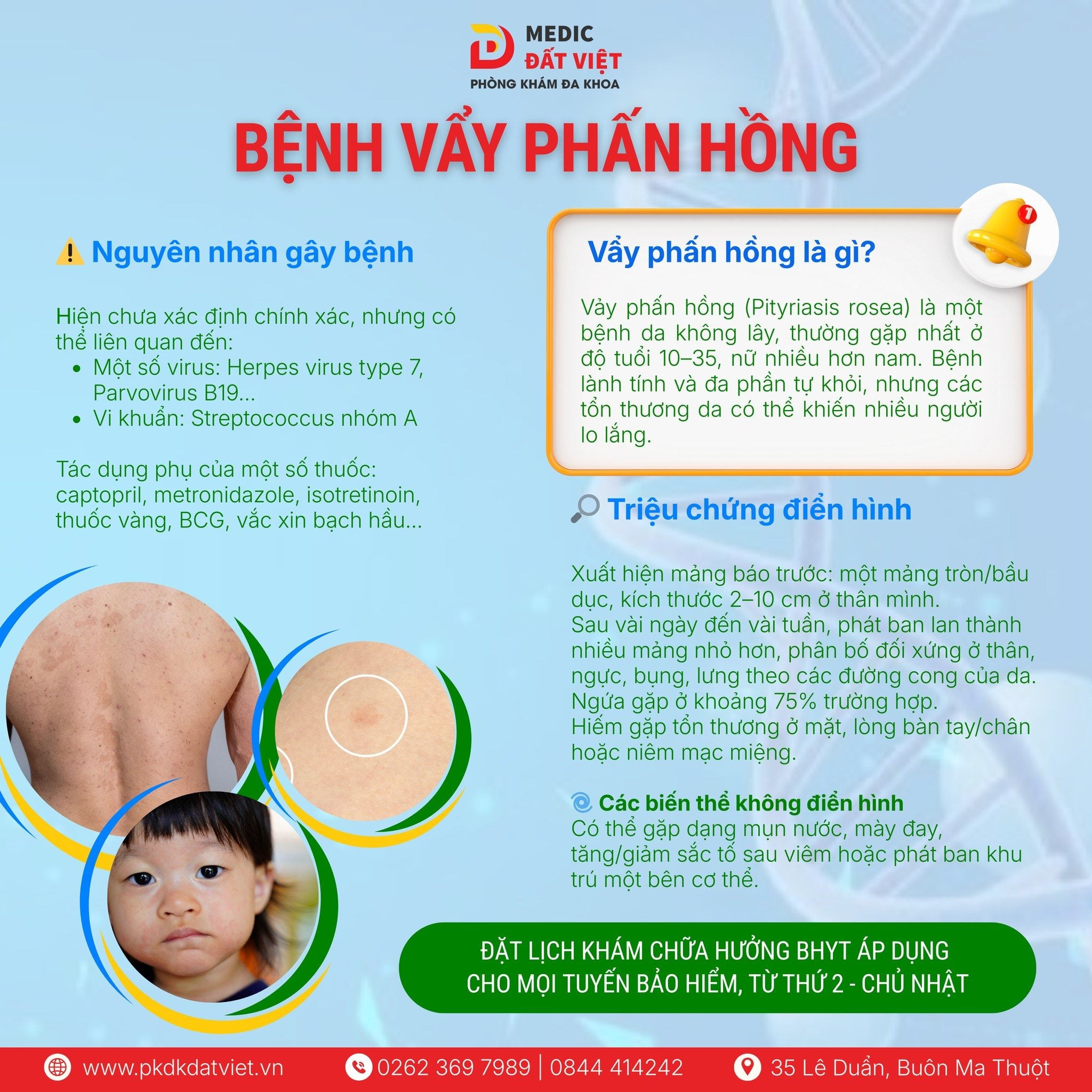 Vảy Phấn Hồng – Bệnh Da Lành Tính, Thường Gặp Ở Người Trẻ