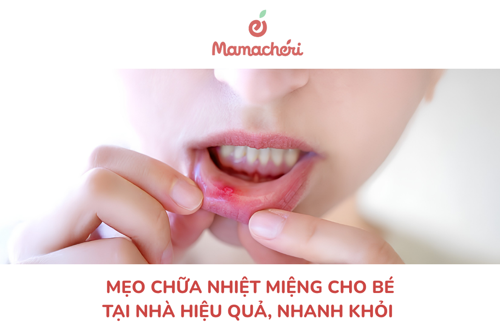 Mẹo chữa nhiệt miệng cho bé tại nhà hiệu quả, nhanh khỏi