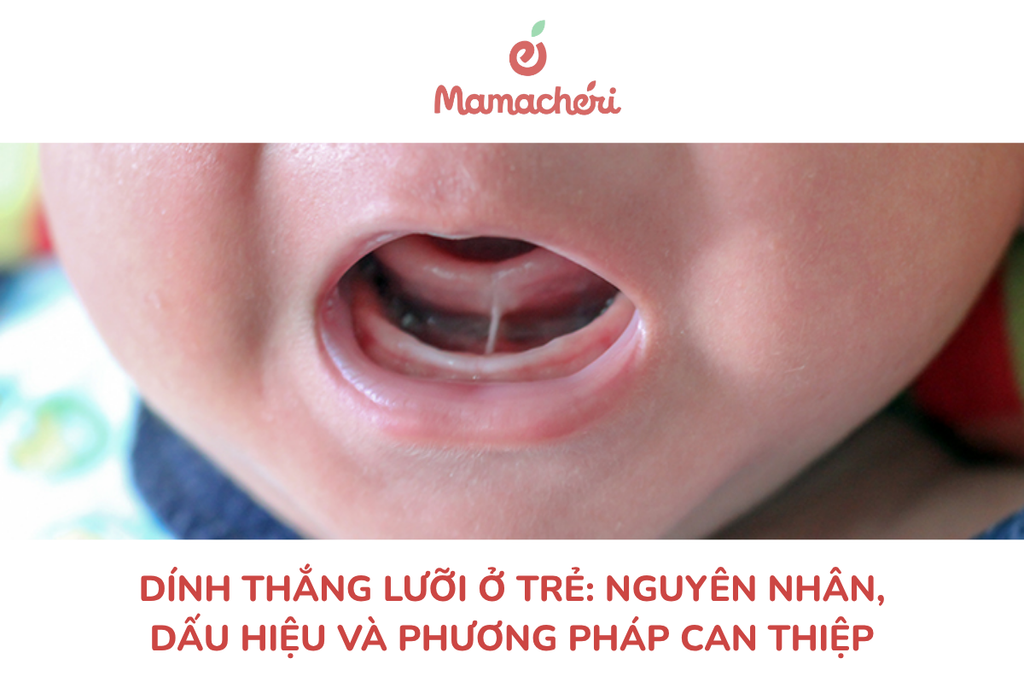 Dính thắng lưỡi ở trẻ: Nguyên nhân, dấu hiệu và phương pháp can thiệp