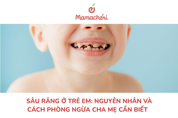 Sâu răng ở trẻ em: nguyên nhân và cách phòng ngừa cha mẹ cần biết