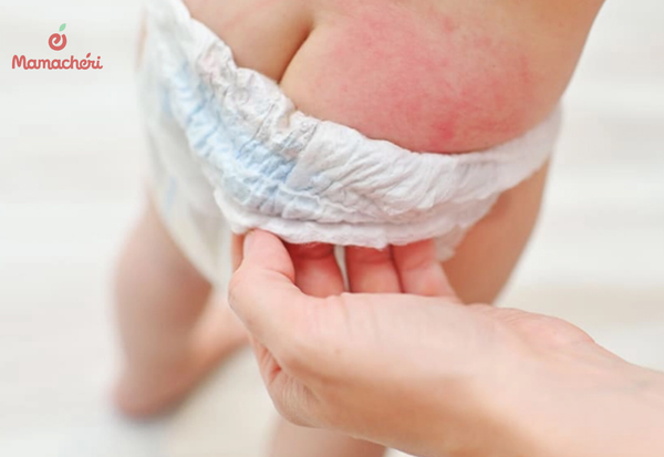 Dấu hiệu nhận biết trẻ sơ sinh bị hăm da