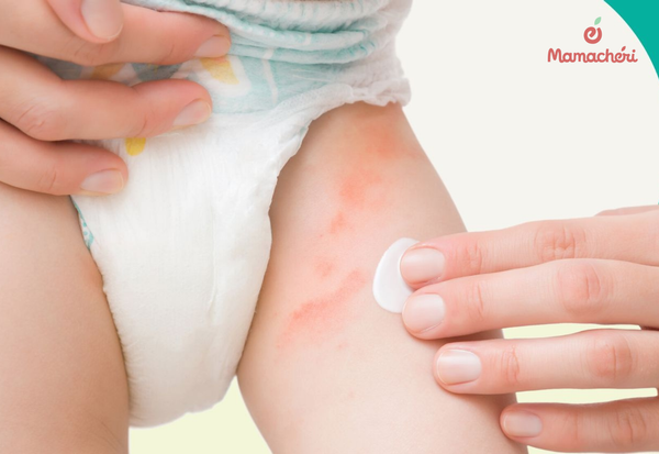 Sử dụng kem chống hăm để trị hăm cho bé được nhanh hơn