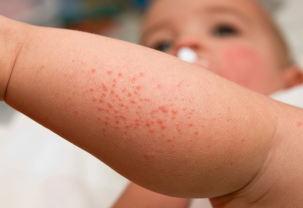 Một số lưu ý quan trọng về cách trị hăm cho bé sơ sinh
