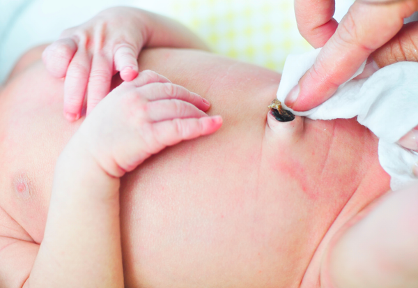 Các bước vệ sinh rốn cho trẻ sơ sinh khi cuống rốn chưa rụng