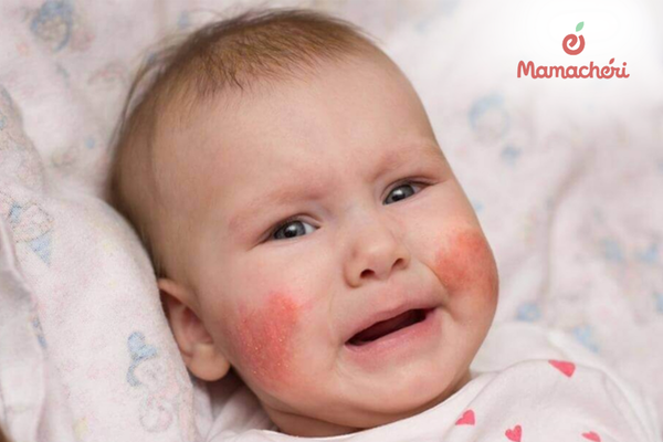 Làn da nhạy cảm của bé cần sự quan sát tinh tế để nhận diện sớm các dấu hiệu chàm sữa