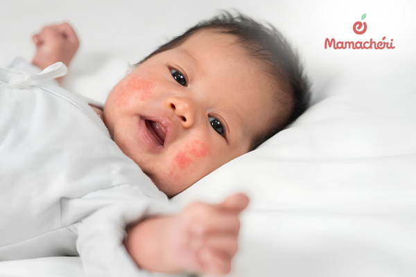 Giấc ngủ của con có thể bị ảnh hưởng nếu cơn ngứa do chàm không được xoa dịu