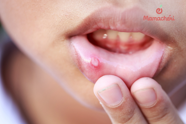 Nhận diện đúng vết loét giúp mẹ bình tĩnh hơn trong việc chăm sóc con yêu