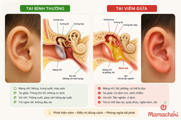 Viêm tai giữa ở trẻ sơ sinh và trẻ nhỏ là gì?