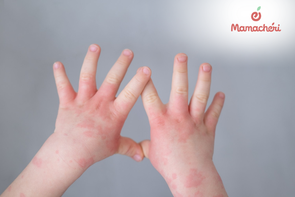 Những nốt mẩn đỏ trên da thường là tín hiệu báo động sớm từ hệ miễn dịch của con