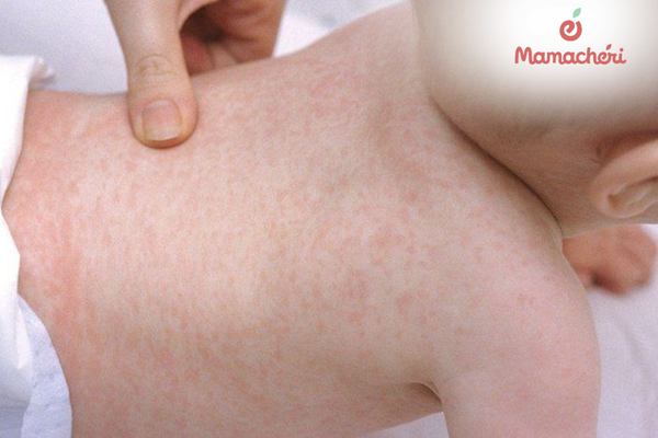 Những nốt ban hồng sau sốt thường là dấu hiệu của bệnh ban đào lành tính
