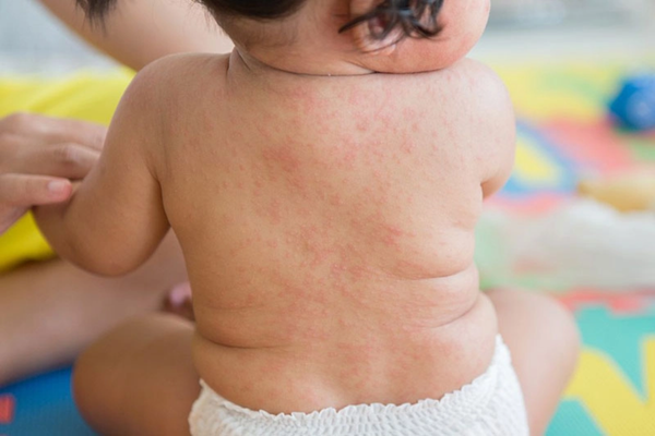 Hiểu rõ các nguyên nhân giúp mẹ chủ động hơn trong việc phòng ngừa và chăm sóc con