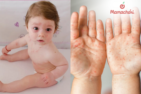 Quan sát thứ tự xuất hiện của ban giúp mẹ nhận diện đúng tình trạng sức khỏe của bé