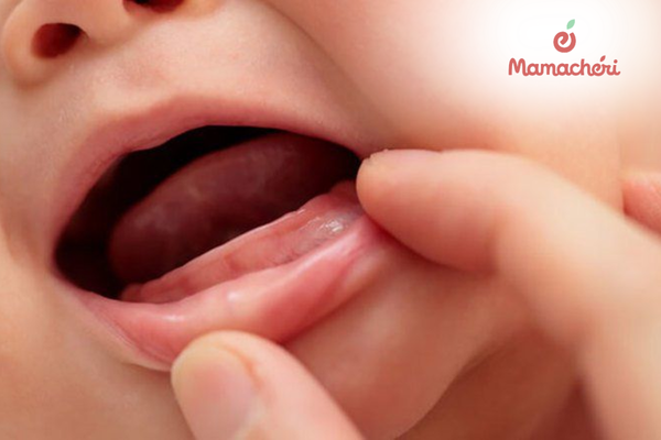 Dấu hiệu trẻ bị nhiệt miệng như xuất hiện vết loét, chảy dãi, quấy khóc và bỏ ăn