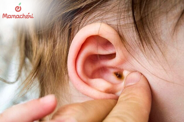 Giải đáp nguyên nhân vì sao viêm tai giữa ở trẻ rất dễ tái phát do cấu trúc giải phẫu và hệ miễn dịch non yếu