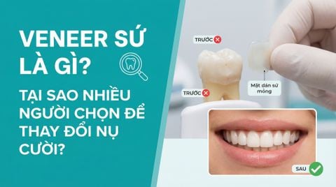 Bọc răng sứ là gì? Vì sao nhiều người lựa chọn để thay đổi nụ cười?