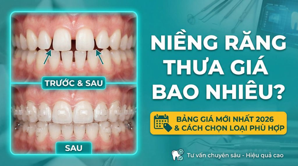 Niềng răng thưa giá bao nhiêu? Bảng Bảng giá niềng răng thưa mới nhất 2026 & cách chọn phù hợp