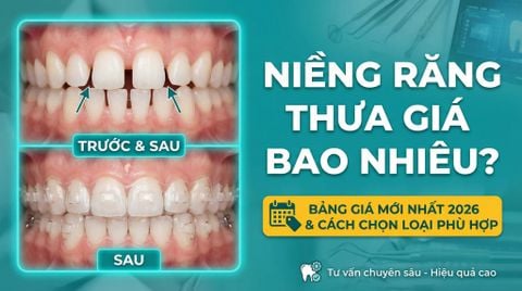 Niềng răng thưa giá bao nhiêu? Bảng Bảng giá niềng răng thưa mới nhất 2026 & cách chọn phù hợp