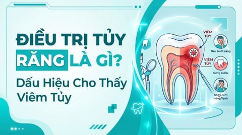 Chữa tủy răng là gì? Dấu hiệu cho thấy răng đã bị viêm tủy
