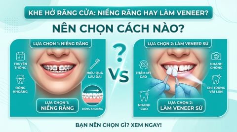Răng cửa thưa có niềng được không hay phải bọc sứ? Nên chọn cách nào
