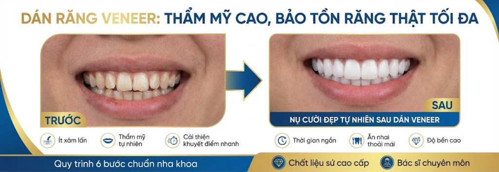 Dán răng veneer là gì? Dán veneer có tốt không?