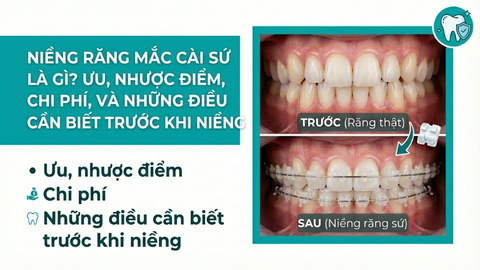 Niềng răng sứ là gì? Ưu nhược điểm, chi phí và những điều cần biết trước khi niềng