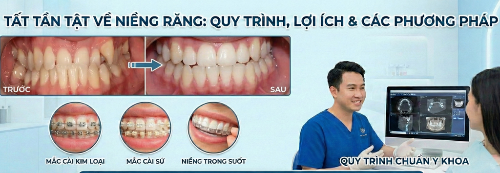 Niềng răng: Quy trình, công dụng và chi phí