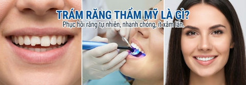 Trám răng thẩm mỹ là gì và khi nào nên thực hiện?