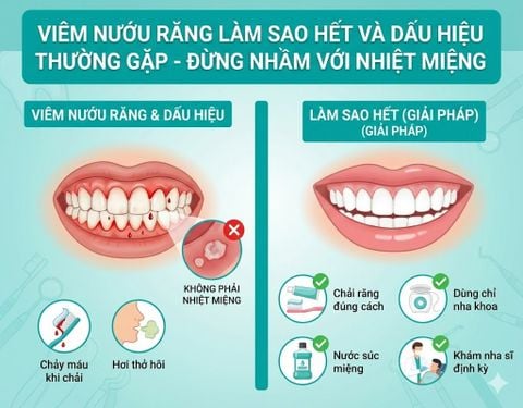 Viêm nướu răng làm sao hết và dấu hiệu thường gặp - Đừng nhầm với nhiệt miệng