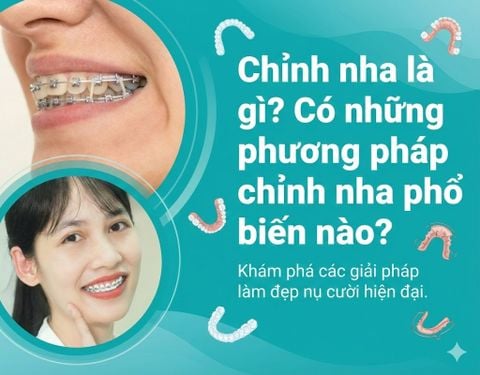 Chỉnh nha là gì? Có những phương pháp chỉnh nha phổ biến nào?