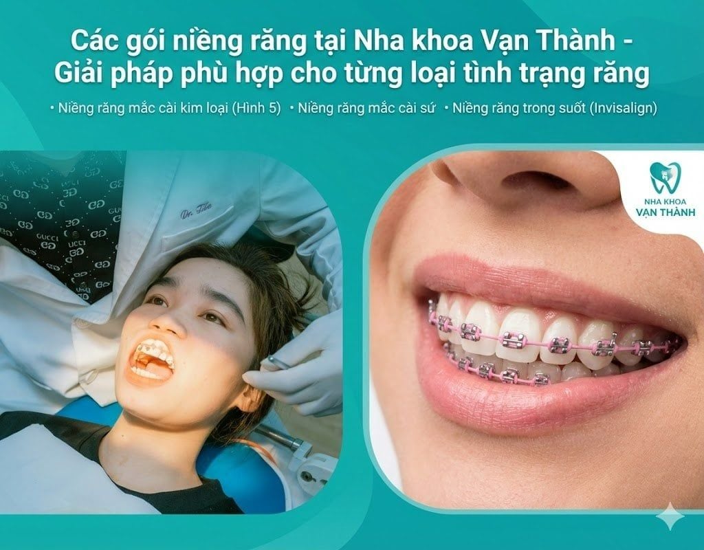Các gói niềng răng tại Nha khoa Vạn Thành - Giải pháp phù hợp cho từng loại tình trạng răng