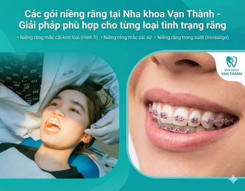 Các gói niềng răng tại Nha khoa Vạn Thành - Giải pháp phù hợp cho từng loại tình trạng răng