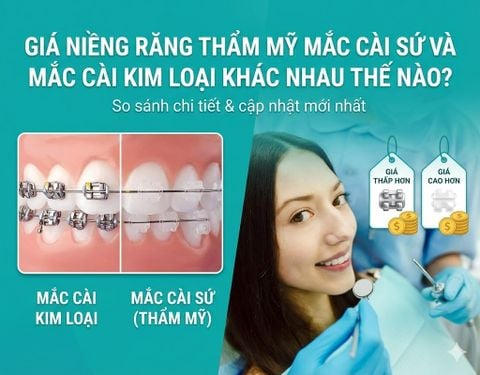 Giá niềng răng thẩm mỹ mắc cài sứ và mắc cài kim loại khác nhau thế nào?