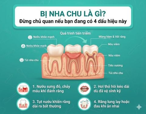 Bị nha chu là gì? Đừng chủ quan nếu bạn đang có 4 dấu hiệu này