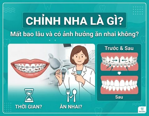 Chỉnh nha là gì? Mất bao lâu và có ảnh hưởng ăn nhai không?