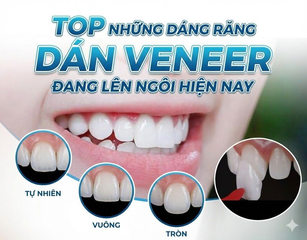 Top những dáng răng dán veneer đang lên ngôi hiện nay